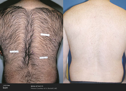 before and after laser hair removal