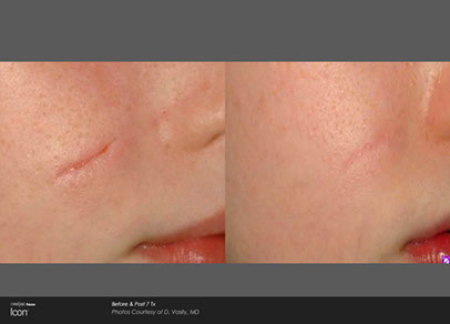 before and after scar treatment