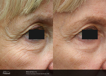 before and after wrinkle treatment