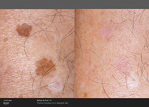 before and after skin rejuvenation 